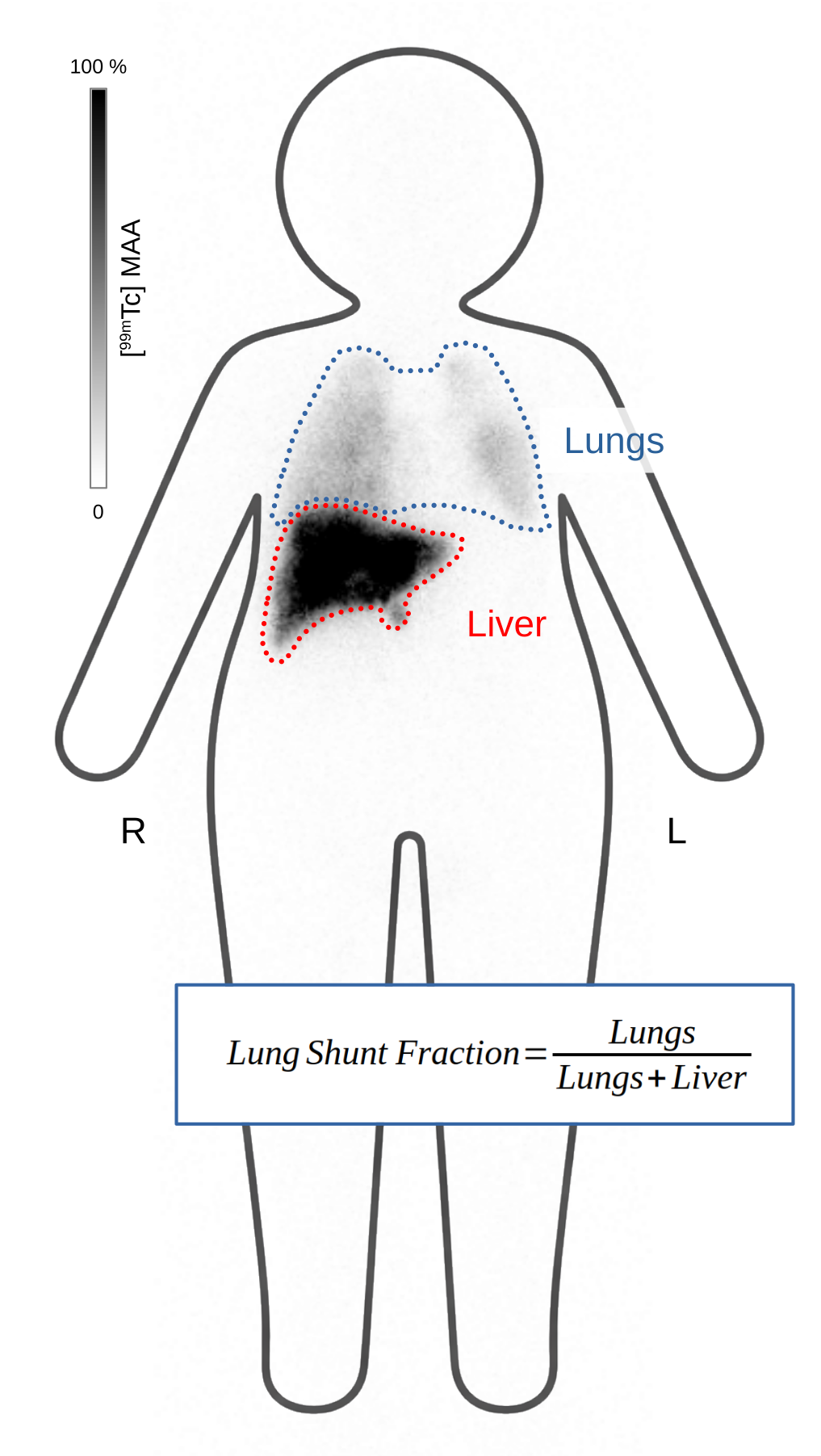 Lung Shunt Fraction ROIs